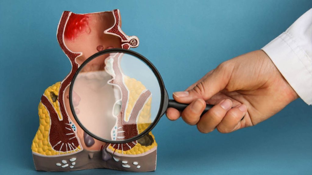 آیا شقاق باعث سرطان می‌شود؟
