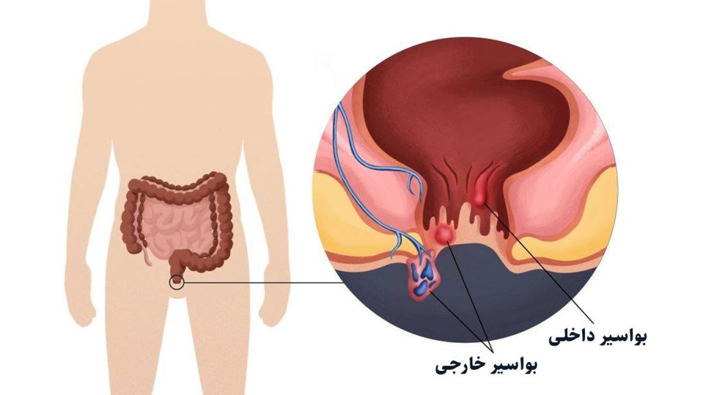 درمان بواسیر خونی چگونه انجام می‌شود؟