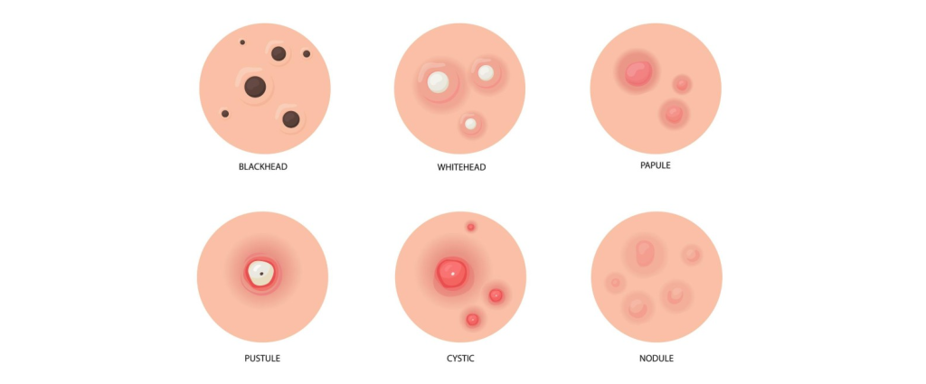 نمایی از زگیل تناسلی